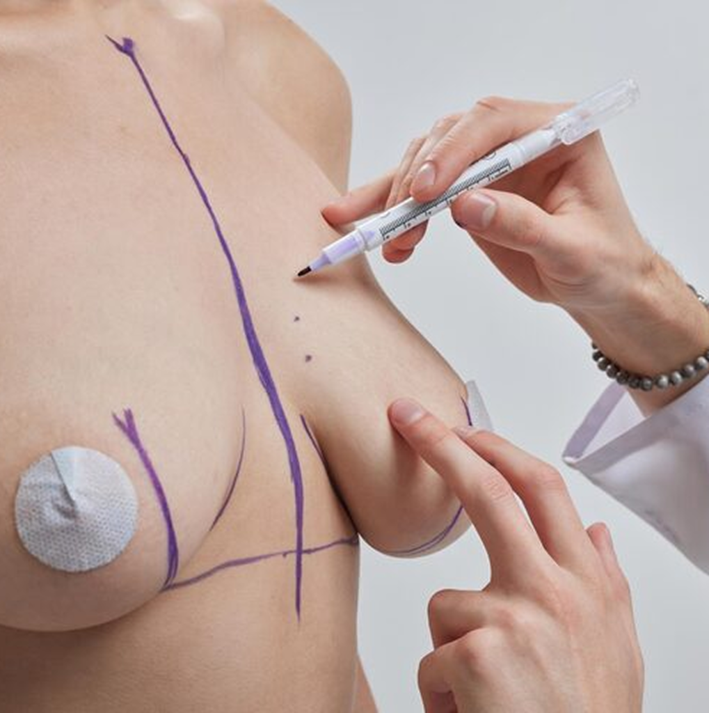Breast cosmetic surgery at Lavanya, Jaipur